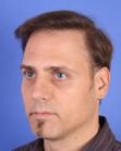 After Hair Transplant&nbsp;Revision